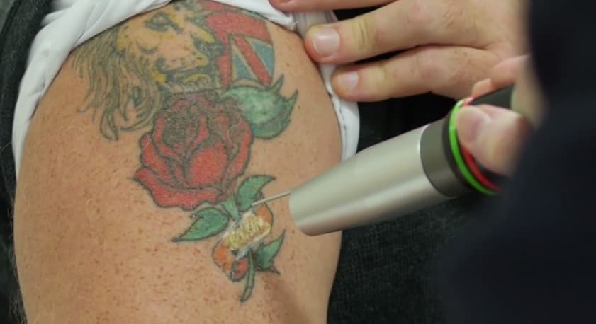 RevLite Laser Tattoo Removal | Andrea Catton Laser Clinic