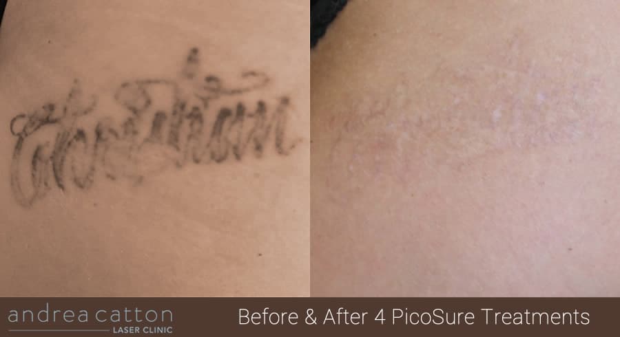 PicoSure Tattoo Removal Client Case Study & Interview 2 Chloe Andrea Catton Laser Clinic