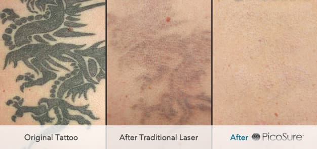 ... to follow our laser tattoo removal before and after care instructions