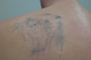 Our First PicoSure Laser Tattoo Removal Treatment is A Roaring Success ...