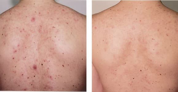 Skin Treatments How You Get Acne Scars Murad Acne Clearing Solution