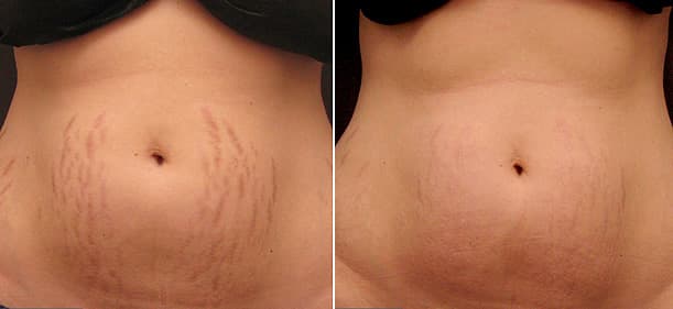 Laser Treatment For Stretch Mark Removal Andrea Catton Laser Clinic