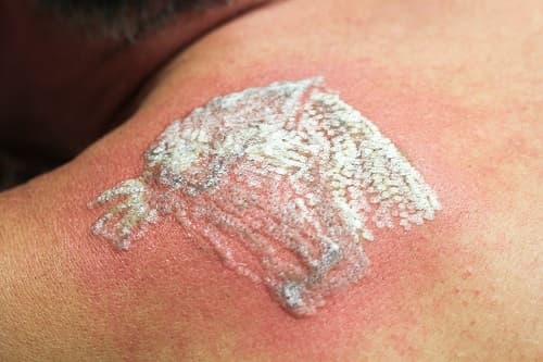 ... frosting caused by laser tattoo removal? | Andrea Catton Laser Clinic
