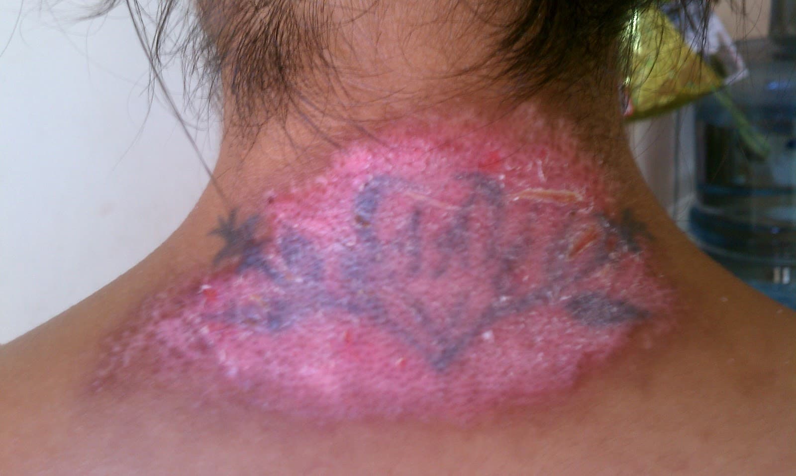 The Dangers and Risks of Non-Laser Tattoo Removal Methods | Andrea ...