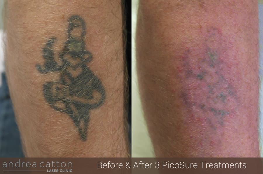 FAQ What are the easiest and hardest tattoo ink colours to remove by laser? Andrea Catton