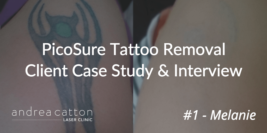 PicoSure Tattoo Removal Client Case Study &amp; Interview #1 ...