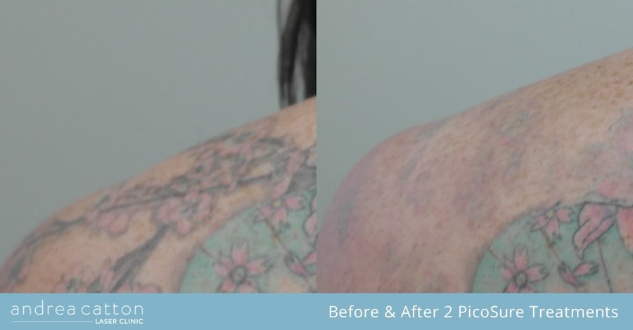 FAQ: What are the easiest and hardest tattoo ink colours to remove by laser?  - Andrea Catton Laser Clinic