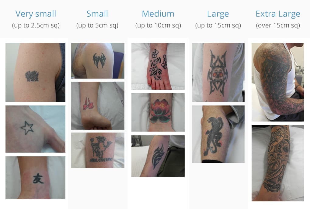FAQ: How Often Can You Get Laser Tattoo Removal? - Andrea Catton Laser  Clinic