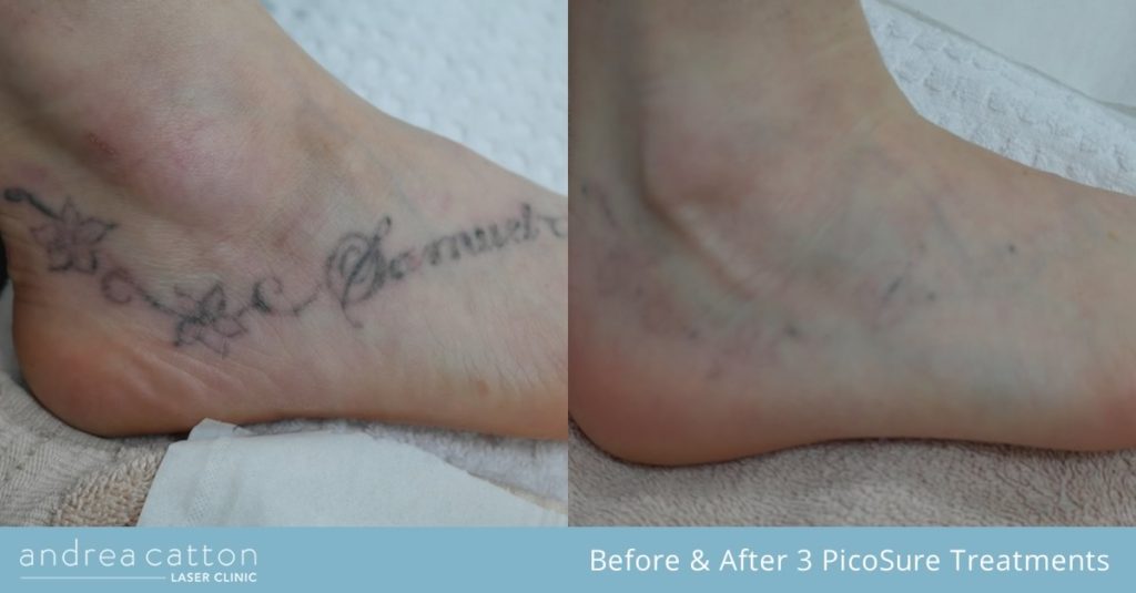 PicoSure® Tattoo Removal UK | Andrea Catton Laser Clinic, Burnley