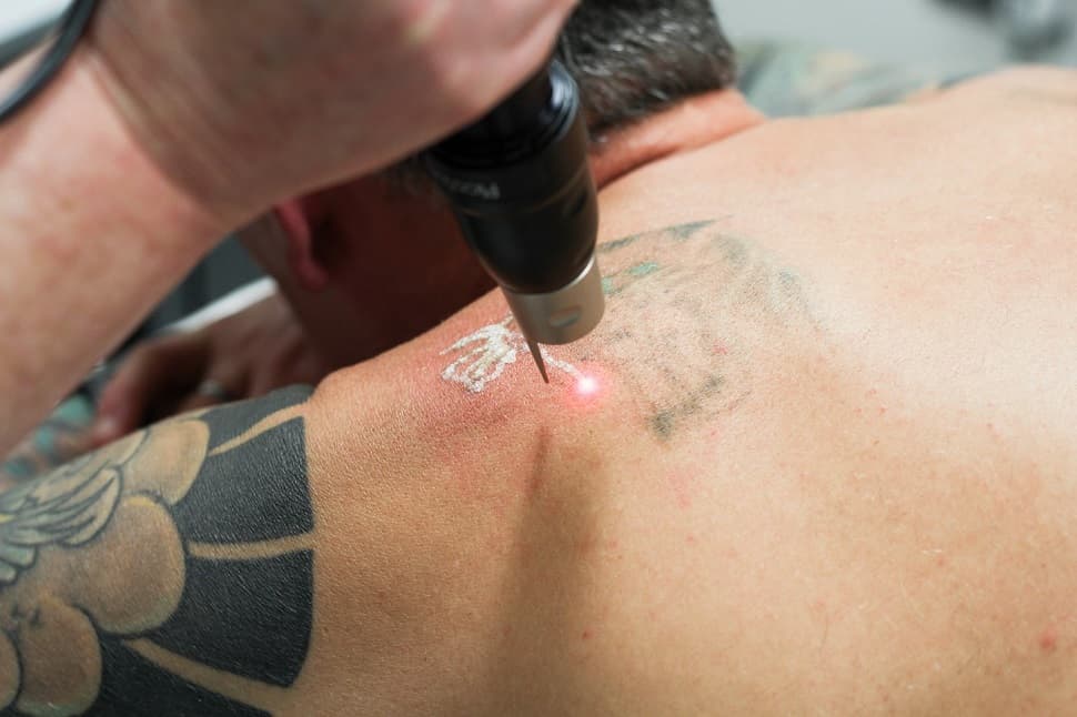 Does Getting A Tattoo Removed Hurt? 