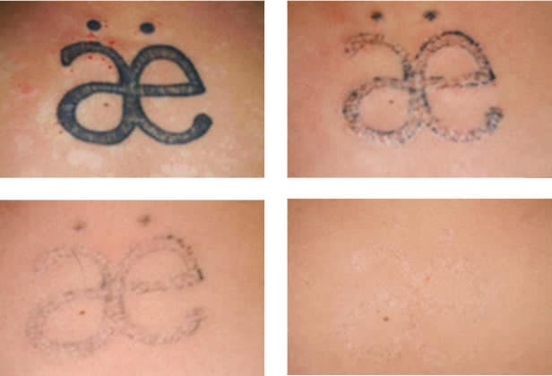 What happens after tattoo laser removal