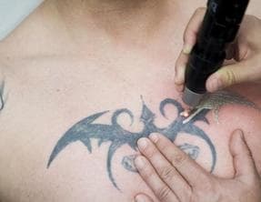 Laser Tattoo Removal before a Cover-Up Tattoo: Is it worth ...