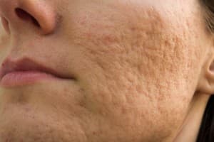 rolling acne scars on woman's cheek