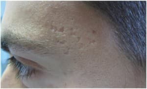 boxcar acne scars
