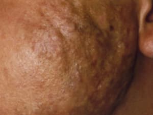 hypertrophic acne scars