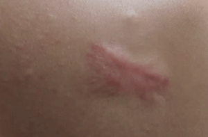 keloid acne scar