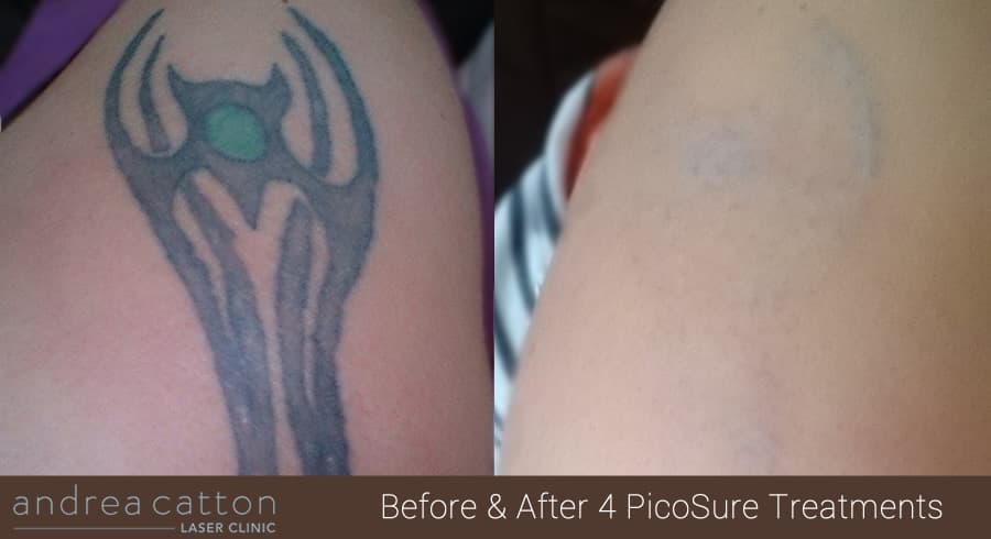 PicoSure Tattoo Removal Client Case Study & Interview #1 - Melanie - Andrea  Catton Laser Clinic