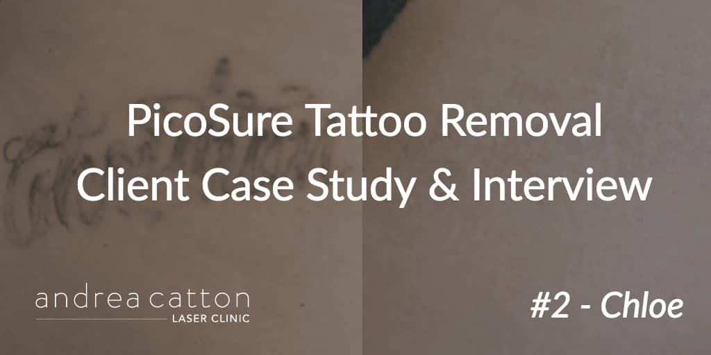 PicoSure Tattoo Removal Client Case Study &amp; Interview #2 