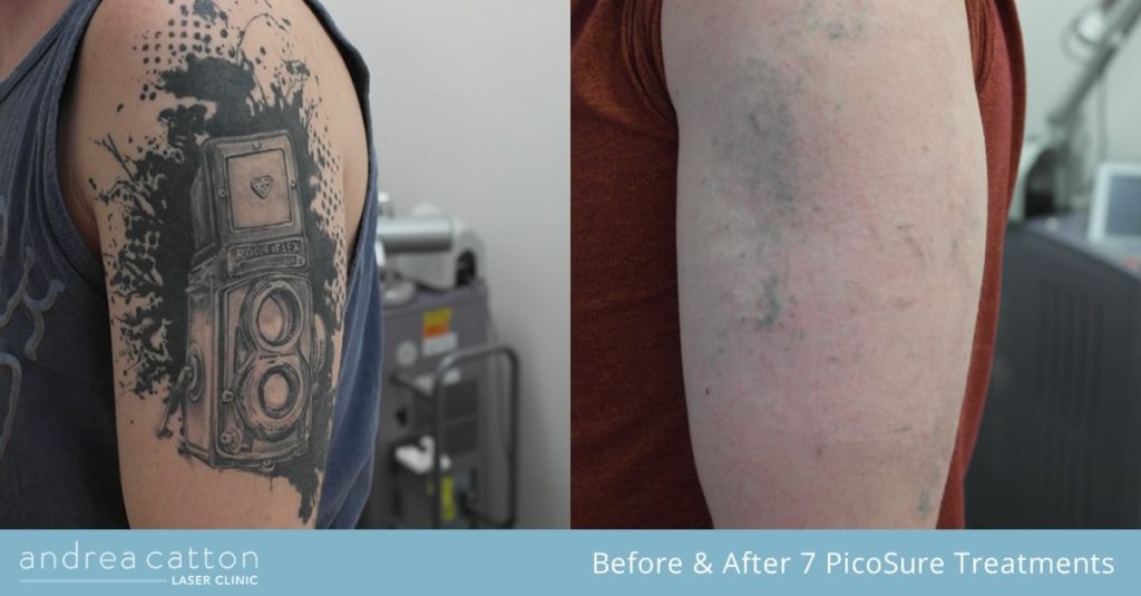Picosure before and after tattoo