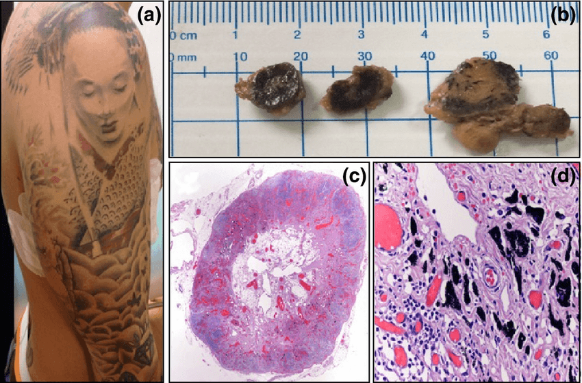 What Happens to Tattoo Ink After It's Injected into Your Skin? | Live  Science