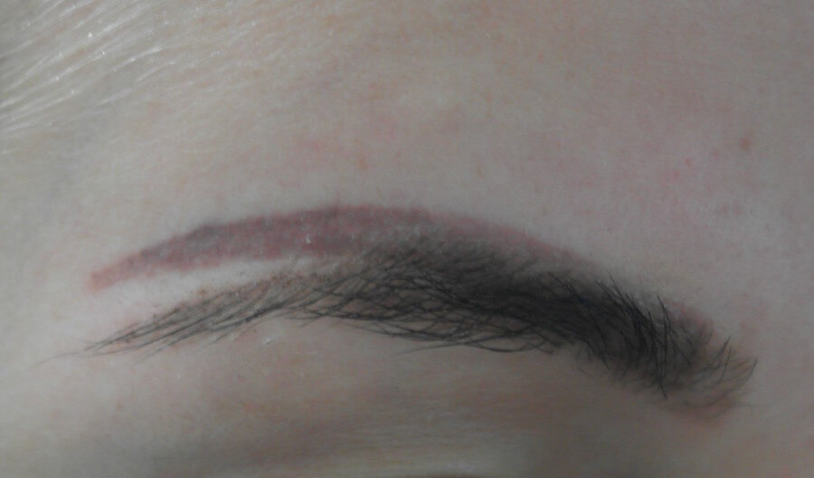 Eyebrow Tattoo Removal: Can Eyebrow Tattoos be Removed by Laser? - Andrea  Catton Laser Clinic