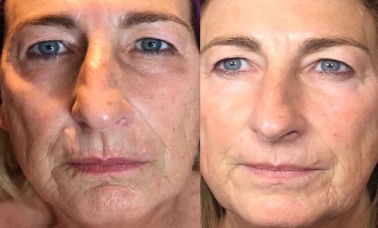 www.andreacatton.co.uk. fillers ageing rejuvenation. 
