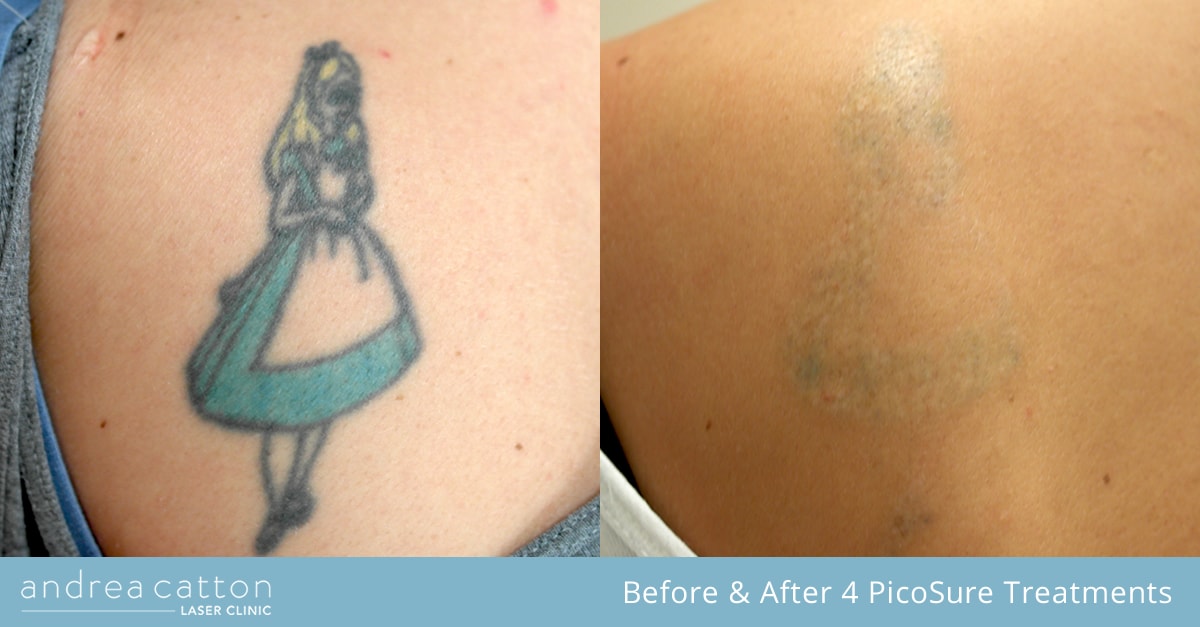 Andrea Catton Laser Clinic | PicoSure® Tattoo Removal & Laser Treatments UK