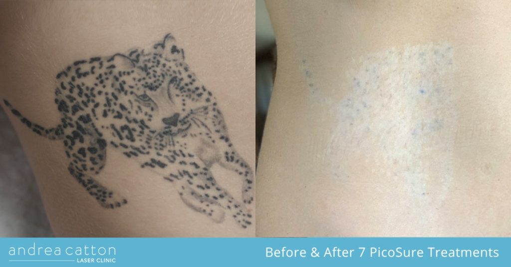PicoSure Tattoo Removal Case Study & Interview #7 – Lauren - Andrea Catton  Laser Clinic